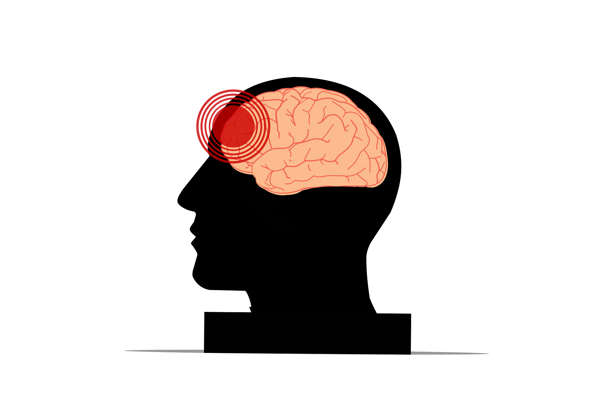 Image of brain injury
